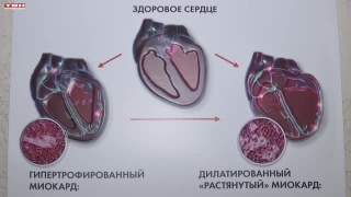 Школа ХСН в поликлинике